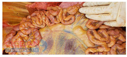 Hạch bạch huyết ruột của bê bệnh do Salmonella sưng to